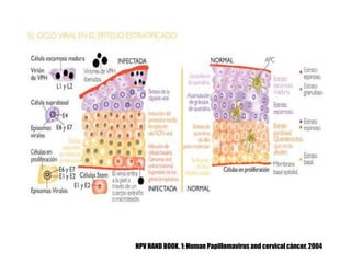 HPV HAND BOOK. 1: Human Papillomavirus and cervical cáncer. 2004
 