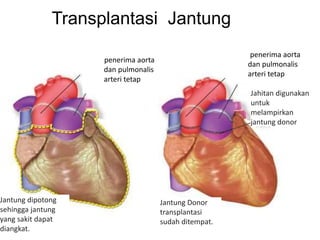 penerima aorta
dan pulmonalis
arteri tetap
penerima aorta
dan pulmonalis
arteri tetap
Jahitan digunakan
untuk
melampirkan
jantung donor
Transplantasi Jantung
Jantung dipotong
sehingga jantung
yang sakit dapat
diangkat.
Jantung Donor
transplantasi
sudah ditempat.
 