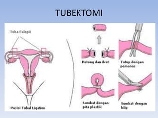 TUBEKTOMI
 