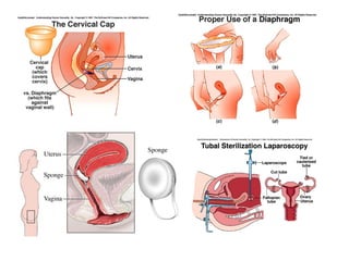 Biologia – 12º Ano (ContracepçãO)