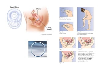Biologia – 12º Ano (ContracepçãO)