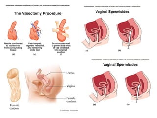 Biologia – 12º Ano (ContracepçãO)