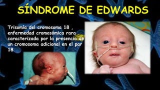 Trisomía del cromosoma 18 ,
enfermedad cromosómica rara
caracterizada por la presencia de
un cromosoma adicional en el par
18
 