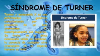 Turner o monosomía X es una
enfermedad genética
caracterizada por la
presencia de un solo
cromosoma X.
Genotípicamente son mujeres.
Se trata, de la única
monosomía viable en humanos,
la carencia de cualquier otro
cromosoma en la especie
humana es letal.
 