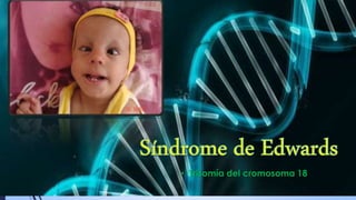 • Trisomía del cromosoma 18
 