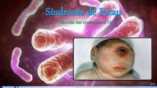 • Trisomía del cromosoma 13
 