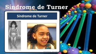 Síndrome de Turner
 