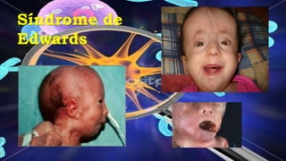 Síndrome de
Edwards
 