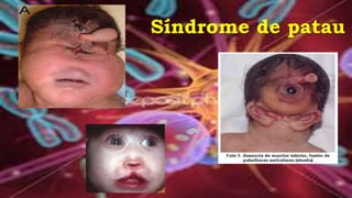 Síndrome de patau
 