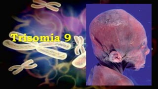 Trisomía 9
 