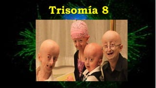Trisomía 8
 