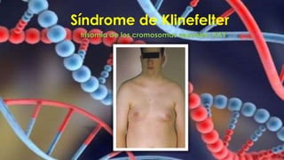 Síndrome de Klinefelter
trisomía de los cromosomas sexuales: XXY
 