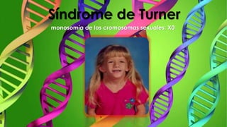 Síndrome de Turner
monosomía de los cromosomas sexuales: X0
 
