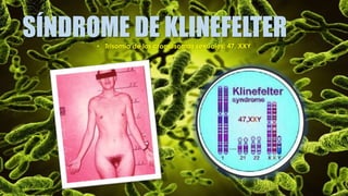 SÍNDROME DE KLINEFELTER• Trisomía de los cromosomas sexuales: 47, XXY
 