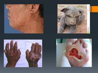 Lepra, coquiluche e bronquite