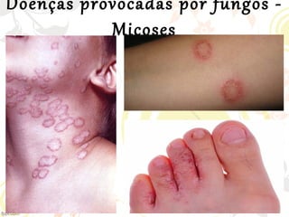 Doenças provocadas por fungos -
Micoses
 