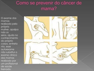 O exame das
mamas
realizado pela
própria
mulher, apalpa
ndo os
seios, ajuda no
conhecimento
do próprio
corpo, entreta
nto, esse
autoexame
não substitui o
exame clínico
das mamas
realizado por
um profissional
de saúde
treinado.
 