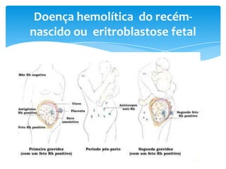 Doença hemolítica do recém-
nascido ou eritroblastose fetal
 