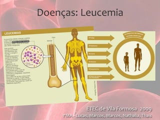 Doenças: Anemia Falciforme