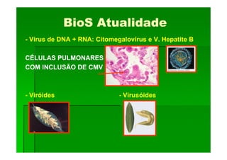 BioS Atualidade
- Vírus de DNA + RNA: Citomegalovírus e V. Hepatite B

CÉLULAS PULMONARES
COM INCLUSÃO DE CMV



- Viróides                   - Virusóides
 