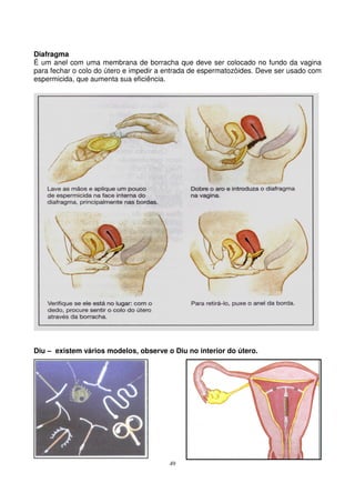 49
Diafragma
É um anel com uma membrana de borracha que deve ser colocado no fundo da vagina
para fechar o colo do útero e impedir a entrada de espermatozóides. Deve ser usado com
espermicida, que aumenta sua eficiência.
Diu – existem vários modelos, observe o Diu no interior do útero.
 