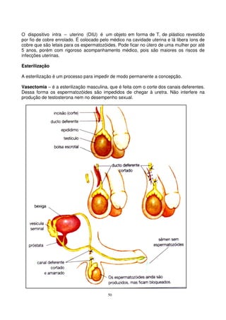 50
O dispositivo intra – uterino (DIU) é um objeto em forma de T, de plástico revestido
por fio de cobre enrolado. É colocado pelo médico na cavidade uterina e lá libera íons de
cobre que são letais para os espermatozóides. Pode ficar no útero de uma mulher por até
5 anos, porém com rigoroso acompanhamento médico, pois são maiores os riscos de
infecções uterinas.
Esterilização
A esterilização é um processo para impedir de modo permanente a concepção.
Vasectomia – é a esterilização masculina, que é feita com o corte dos canais deferentes.
Dessa forma os espermatozóides são impedidos de chegar à uretra. Não interfere na
produção de testosterona nem no desempenho sexual.
 