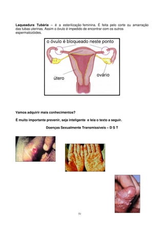 51
Laqueadura Tubária – é a esterilização feminina. É feita pelo corte ou amarração
das tubas uterinas. Assim o óvulo é impedido de encontrar com os outros
espermatozóides.
Vamos adquirir mais conhecimentos?
É muito importante prevenir, seja inteligente e leia o texto a seguir.
Doenças Sexualmente Transmissíveis – D S T
 