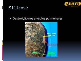 Silicose

 Destruição nos alvéolos pulmonares
 