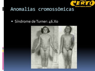 Anomalias cromossômicas

 Síndrome de Turner: 46.X0
 
