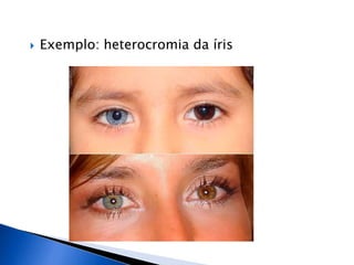  Exemplo: heterocromia da íris
 