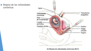  Biopsia de las vellosidades
coriónicas
 