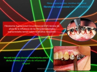 fibras supracrestales :recidiva rotacional
                                         fibrotomia supracrestal circunferencial




Fibrotomía Supracrestal Circunferencial (CSF) técnica de
    alivio de la influencia de las fibra periodontales
   supracrestales tenían sobre la recidiva rotacional.




No está indicado durante movimiento activo
  de los dientes o en casos de inflamación
                   gingival

                                 ANDREA ELIZABETH BERRIOS JARA
 