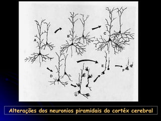 Alterações dos neuronios piramidais do cortéx cerebral 