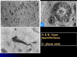 C A & B: fusos neurofibrilares C: placas senis 