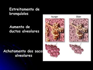 Estreitamento de bronquíolos Aumento de ductos alveolares Achatamento dos sacos alveolares 