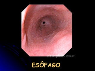 ESÔFAGO 