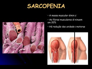 SARCOPENIA A massa muscular diminui As fibras musculares diminuem em 20%  Há redução das unidades motoras 