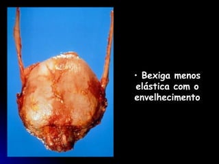 Bexiga menos elástica com o envelhecimento 