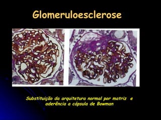 Glomeruloesclerose Substituição da arquitetura normal por matriz  e aderência a cápsula de Bowman 