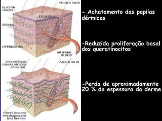 - Achatamento das papilas  dérmicas   -Reduzida proliferação basal  dos queratinocitos -Perda de aproximadamente  20 % da espessura da derme   