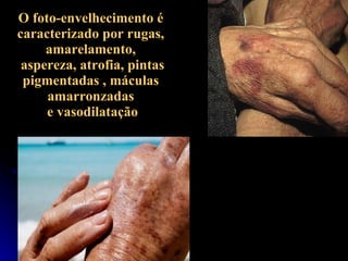 O foto-envelhecimento é caracterizado por rugas, amarelamento, aspereza, atrofia, pintas pigmentadas , máculas amarronzadas e vasodilatação 