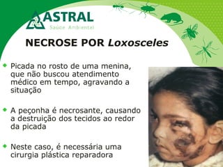 NECROSE POR Loxosceles
 Picada no rosto de uma menina,
que não buscou atendimento
médico em tempo, agravando a
situação
 A peçonha é necrosante, causando
a destruição dos tecidos ao redor
da picada
 Neste caso, é necessária uma
cirurgia plástica reparadora
 