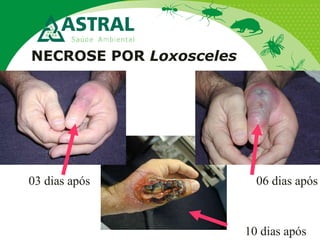 NECROSE POR Loxosceles
03 dias após 06 dias após
10 dias após
 
