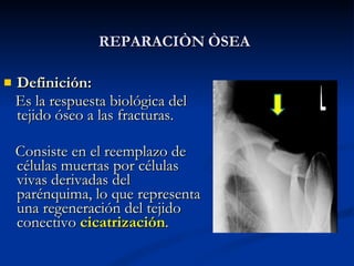 REPARACIÒN   ÒSEA <ul><li>Definición:  </li></ul><ul><li>Es la respuesta biológica del tejido óseo a  las fracturas. </li>...