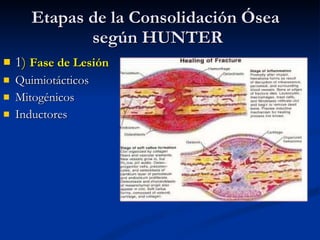 Etapas de la Consolidación Ósea  según HUNTER <ul><li>1 )  Fase de Lesión </li></ul><ul><li>Quimiotácticos  </li></ul><ul>...