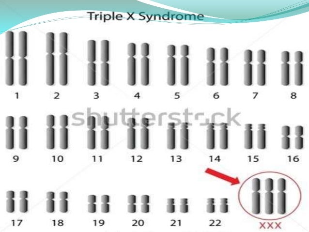 Sindrome del triple "x"