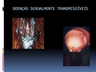 DOENÇAS SEXUALMENTE TRANSMISSÍVEIS
 
