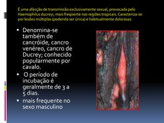 É uma afecção de transmissão exclusivamente sexual, provocada pelo
Haemophilus ducreyi, mais freqüente nas regiões tropicais. Caracteriza-se
por lesões múltiplas (podendo ser única) e habitualmente dolorosas.

 Denomina-se
  também de
  cancróide, cancro
  venéreo, cancro de
  Ducrey; conhecido
  popularmente por
  cavalo.
 O período de
  incubação é
  geralmente de 3 a
  5 dias.
 mais frequente no
  sexo masculino
 