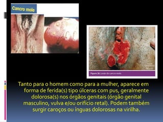 Tanto para o homem como para a mulher, aparece em
  forma de ferida(s) tipo úlceras com pus, geralmente
     dolorosa(s) nos órgãos genitais (órgão genital
  masculino, vulva e/ou orifício retal). Podem também
      surgir caroços ou ínguas dolorosas na virilha.
 