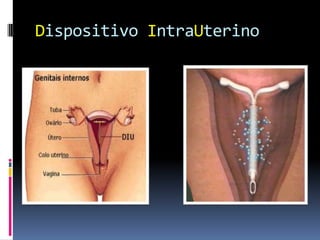 Dispositivo IntraUterino
 